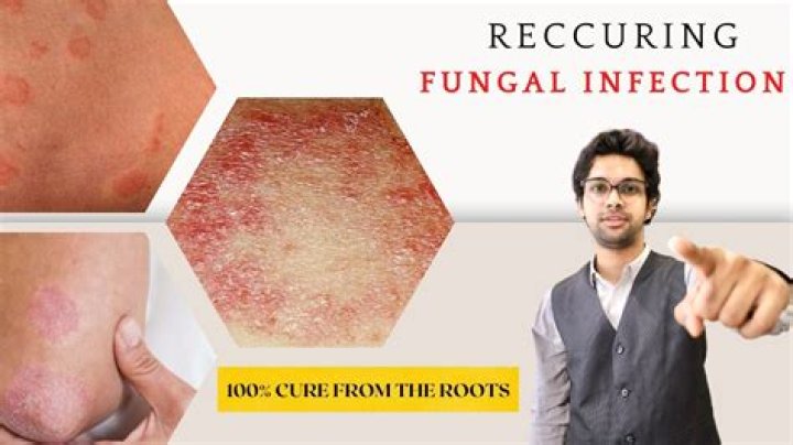 Are fungal infections curable?
