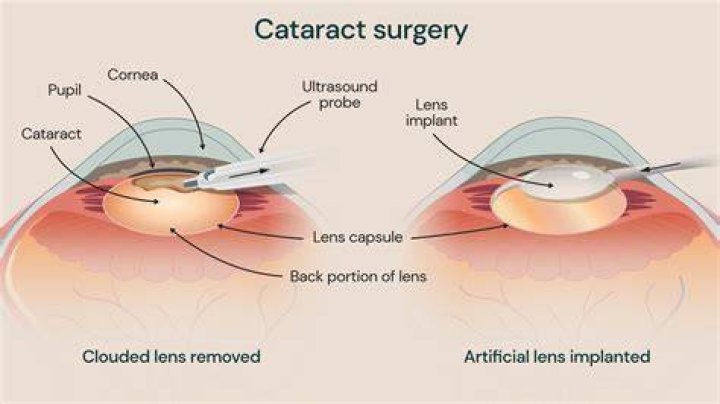 Are you groggy after cataract surgery?