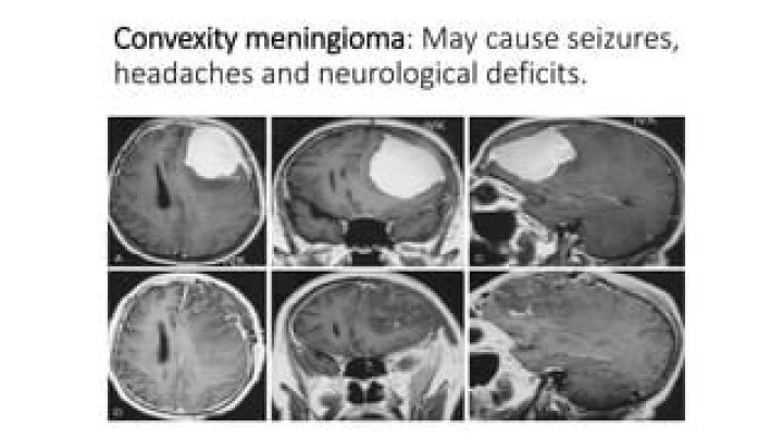 Can a meningioma cause seizures?