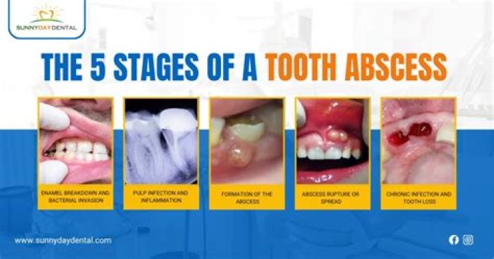 Can an abscess heal on its own?