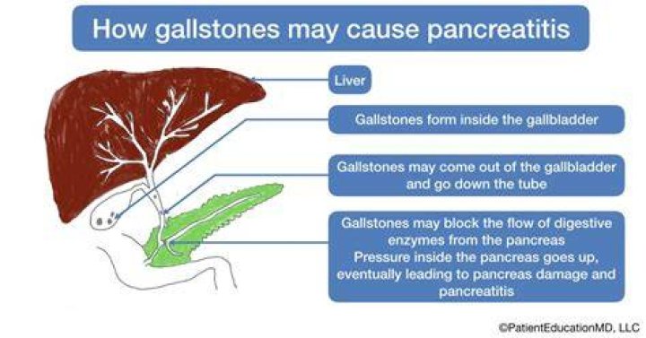 Can gallstones cause pancreatitis?