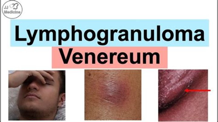 Can lymphogranuloma venereum be cured?