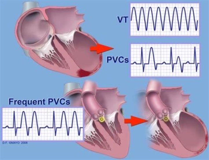 Can pvcs be ablated?