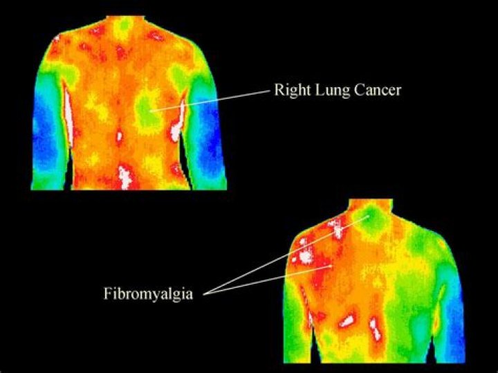 Can thermography detect lung cancer?