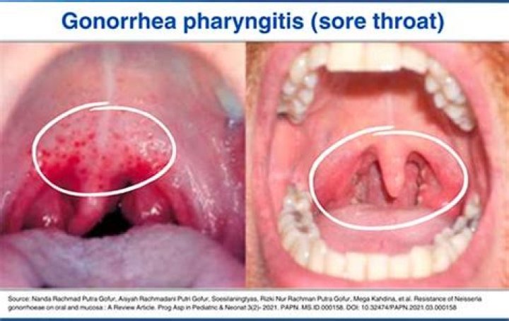 Could i have an std in my throat?