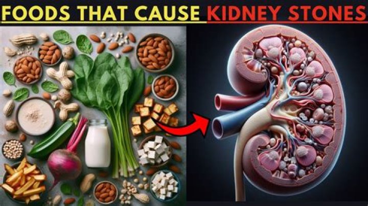 Do green peas cause kidney stones?