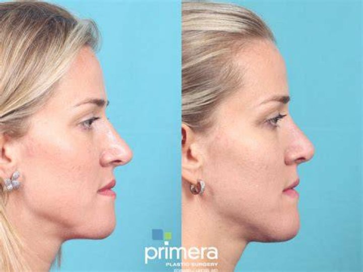 Do nose jobs look unnatural?