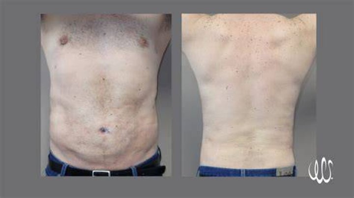 Do you lose weight with laser lipo?