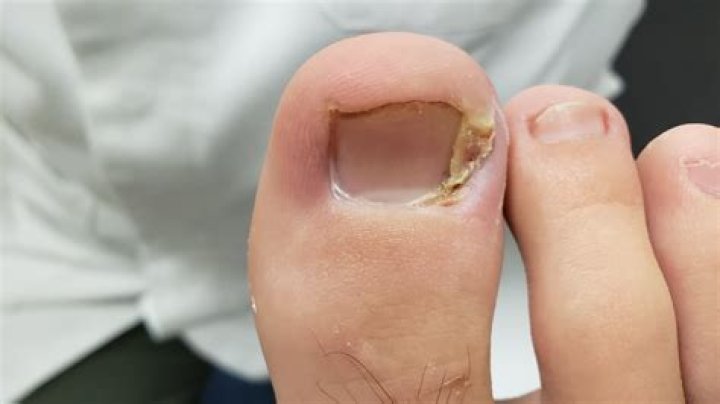 Does iodine cure toenail fungus?