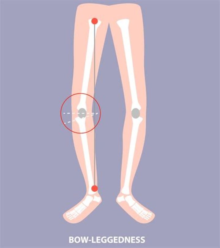 Has my baby got bowed legs?