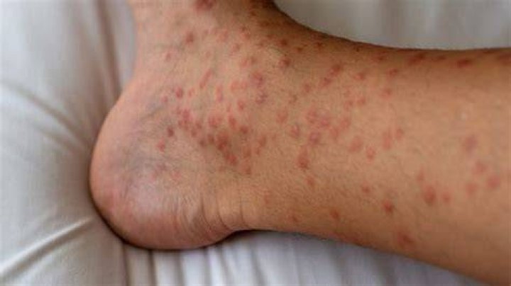How does cholinergic urticaria develop?