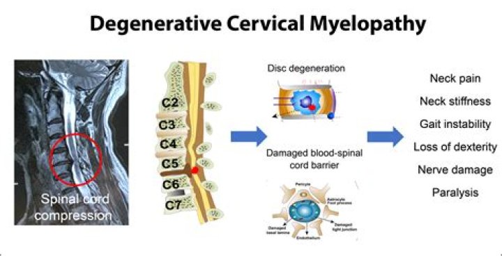 How is degenerative myelopathy diagnosed?