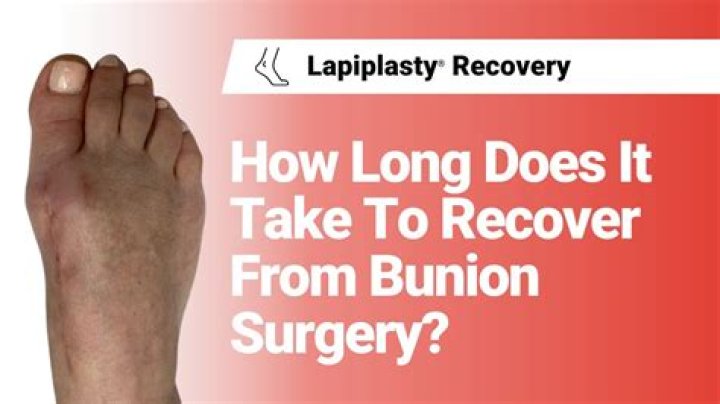 How long to ice foot after bunion surgery?
