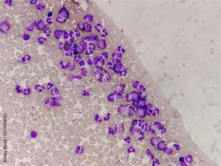 Is chronic granulocytic leukemia a type of cancer?