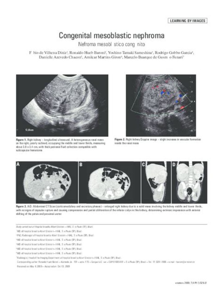 Is congenital mesoblastic nephroma cancer?