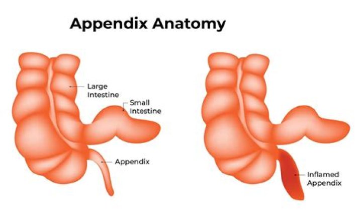 Is the appendiceal orifice part of the appendix?