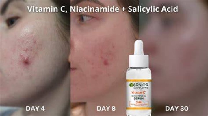 Should acne prone skin use vitamin c?