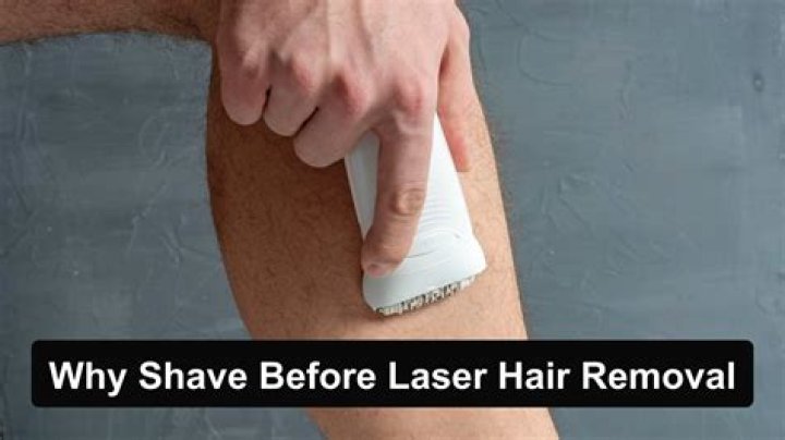 Should shave before laser hair removal?