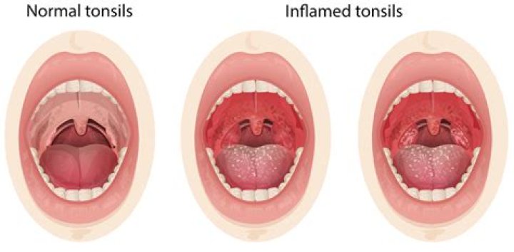 Should throat feel lumpy?