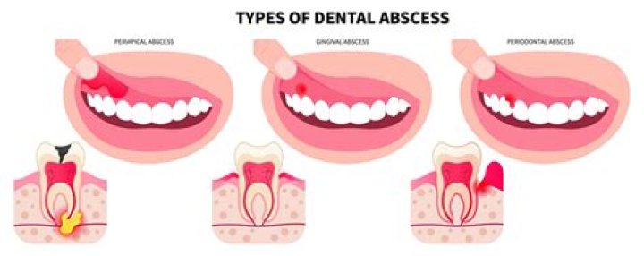 Should you pop a mouth abscess?