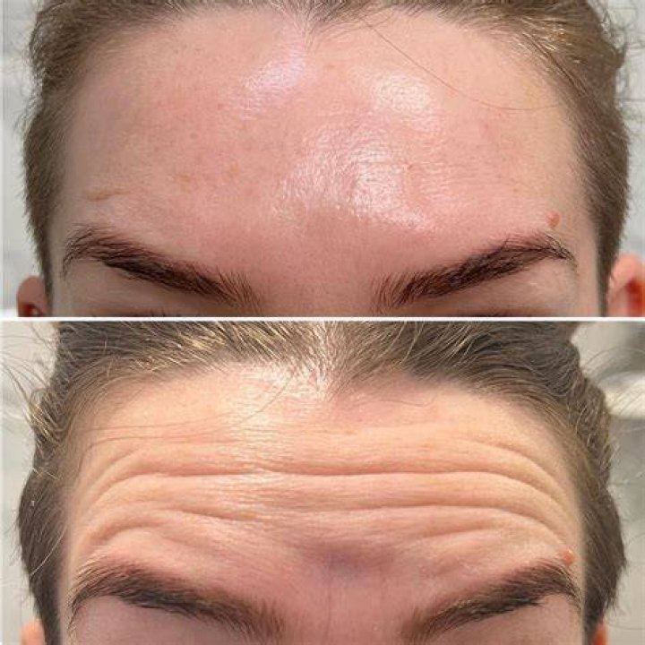 Should you still be able to frown after botox?