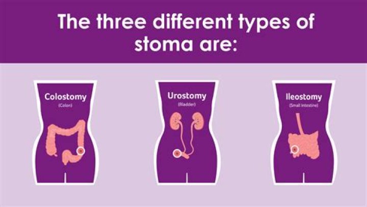What are the different types of stoma?