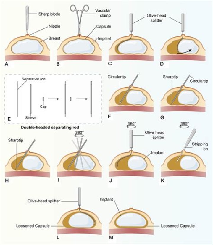 What is a capsulotomy of the breast?