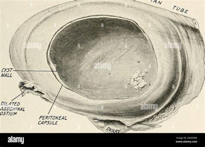 What is a fimbrial cyst?