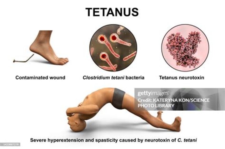What is a sign of tetanus?