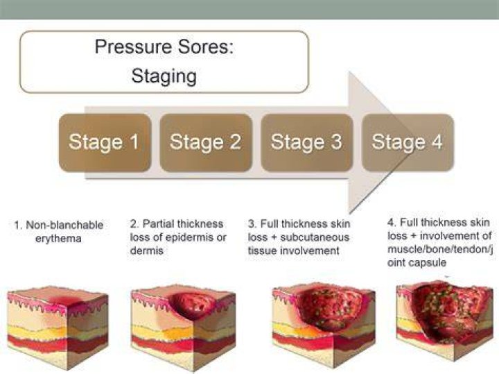 What is a stage 4 decubitus ulcer?