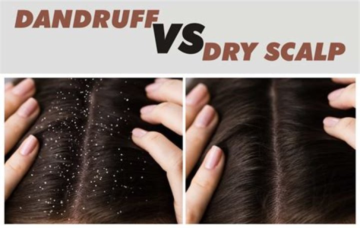 What is anti dandruff means?