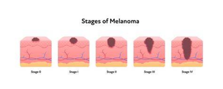What is melanoma medical term?