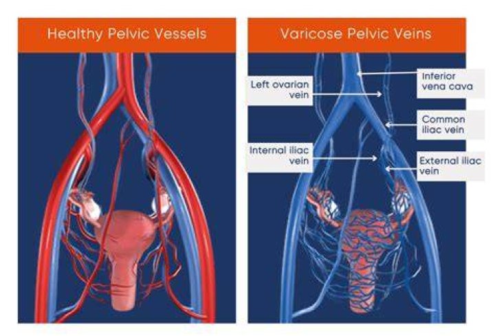 What is periuterine varices?