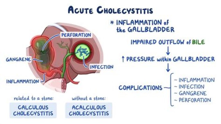 What is the main cause of cholecystitis?
