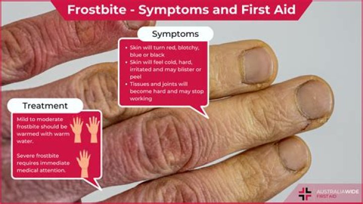 Whats the symptoms of frostbite?