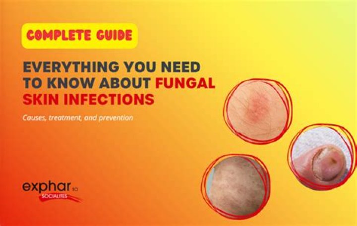 When does fungal infection go away?
