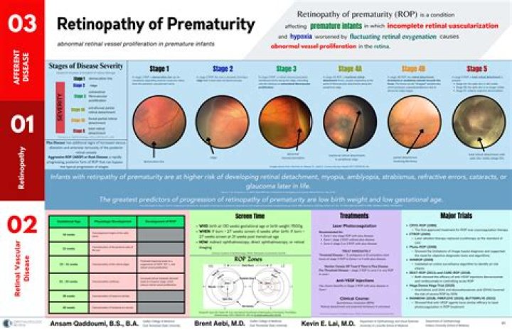 When to screen for retinopathy of prematurity?