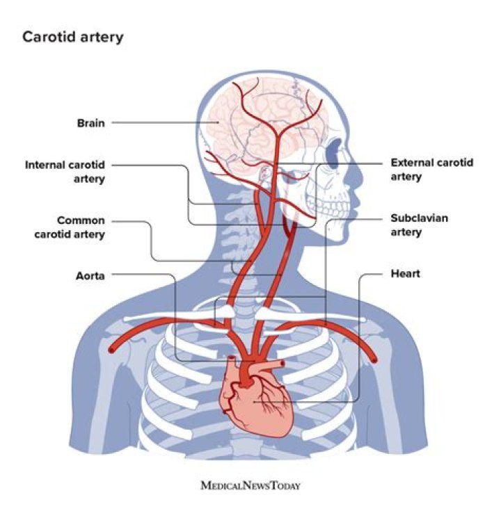 Where are carotid bruits best heard?