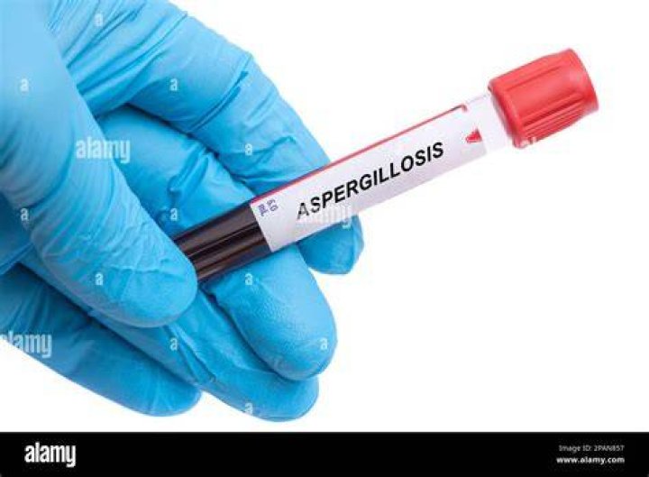 Which doctor treats aspergillosis?