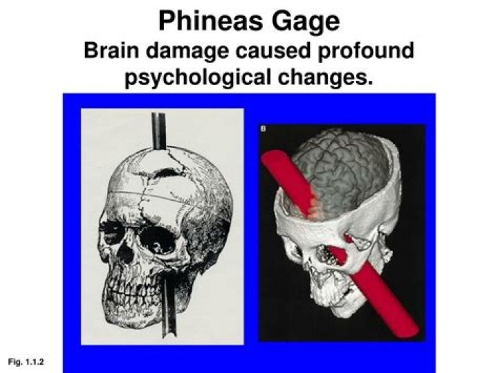 Which part of phineas gage's brain was damaged?