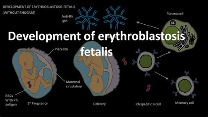 Who does erythroblastosis fetalis affect?