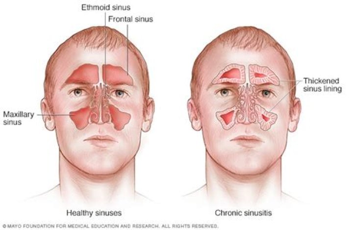 Why are my sinuses so dry?