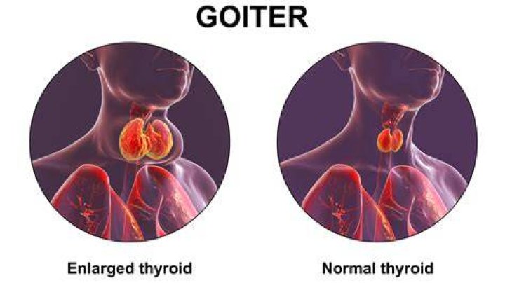 Why does goitre occur?