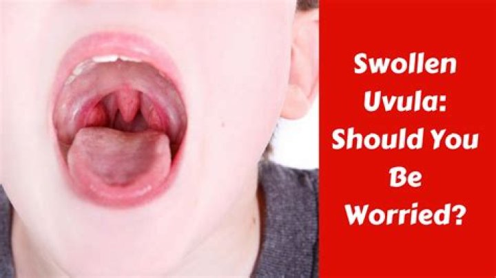 Why is my uvula really swollen?