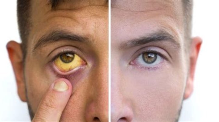 Why jaundice is seen in sclera?