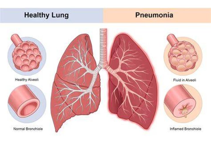 Why sedate a patient with pneumonia?