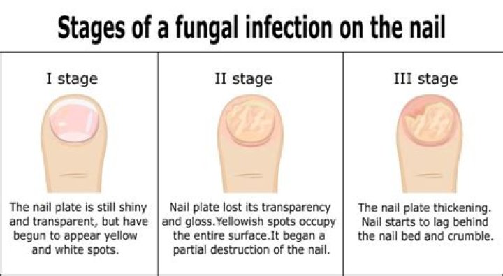 Will a fungal toenail infection go away?