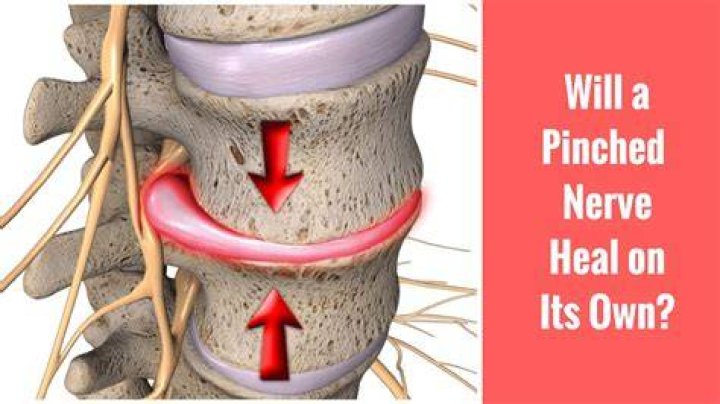 Will a pinched nerve heal on its own?