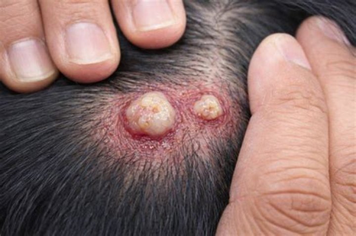 Will my mucous cyst go away?