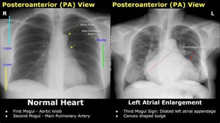Would a chest xray show heart problems?